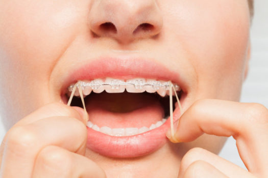 The Importance of Orthodontic Elastics