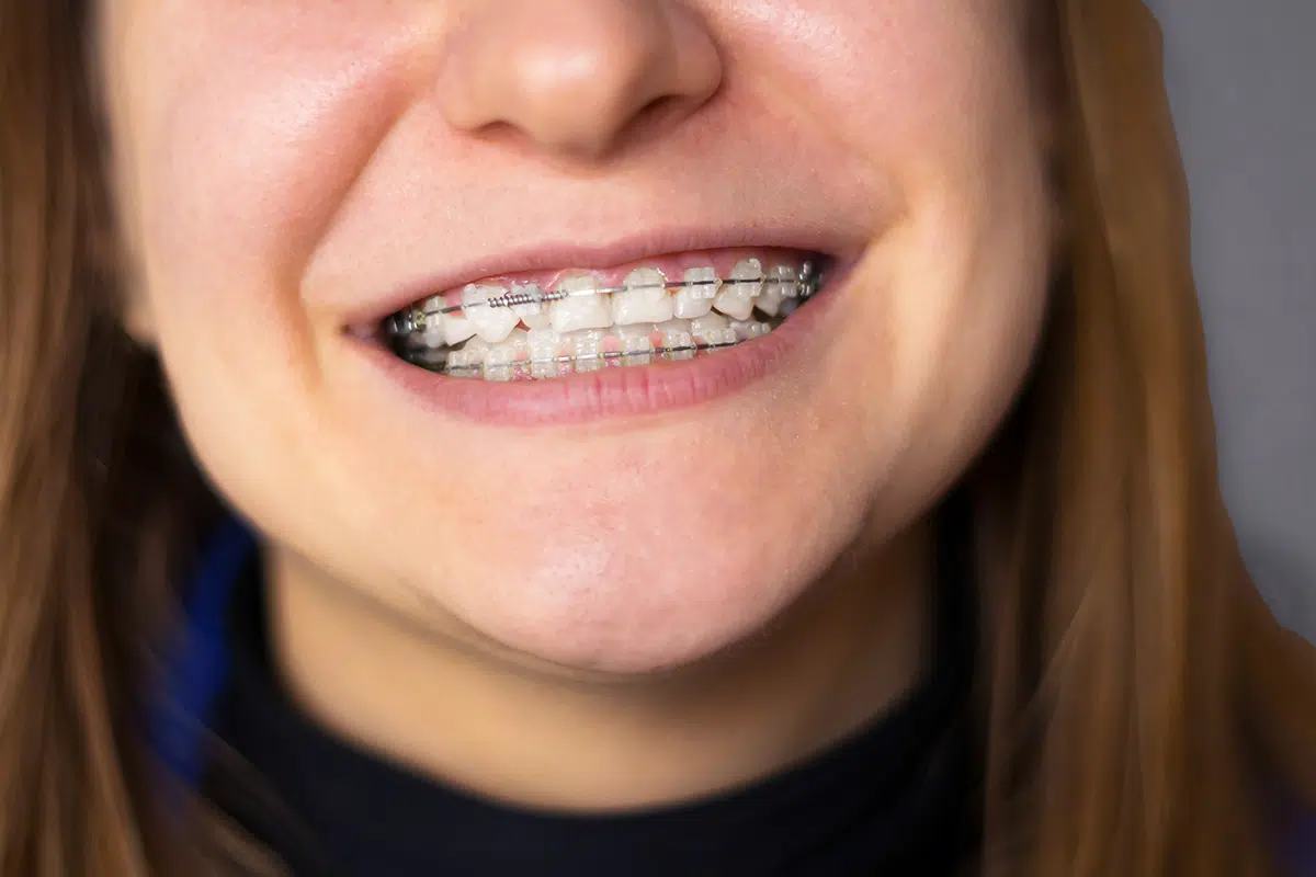 5 Simple Tips to Relieve Sore Teeth After Braces Tightening