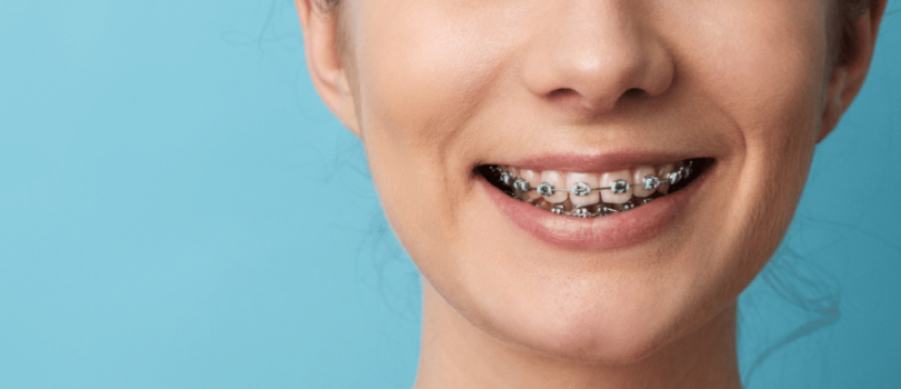 a close up of a woman's mouth with teal braces on her teeth
