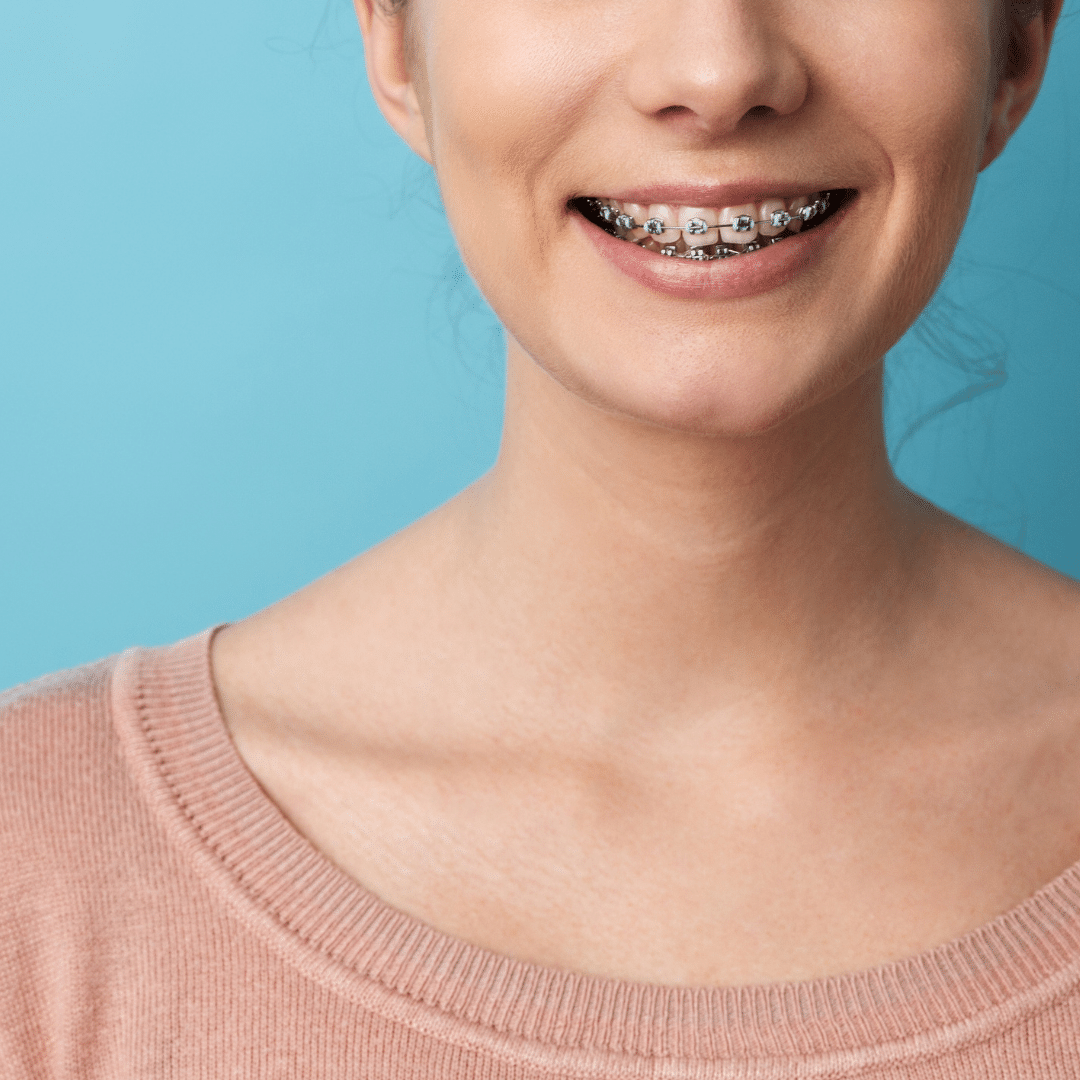 3 Things You Should Know About Getting Braces Off