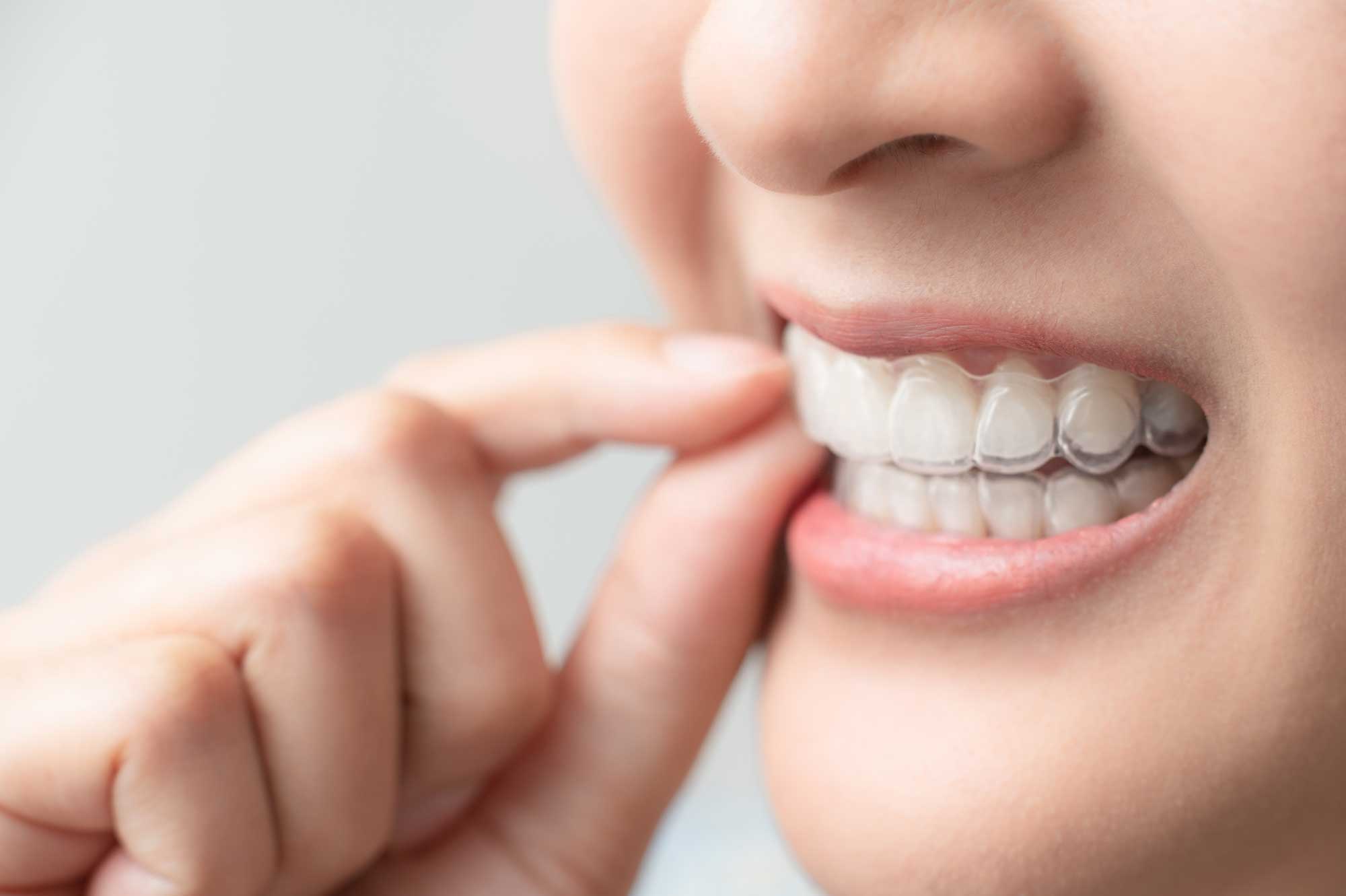 Our Top 6 Most Commonly Asked Questions We Get from Invisalign Patients